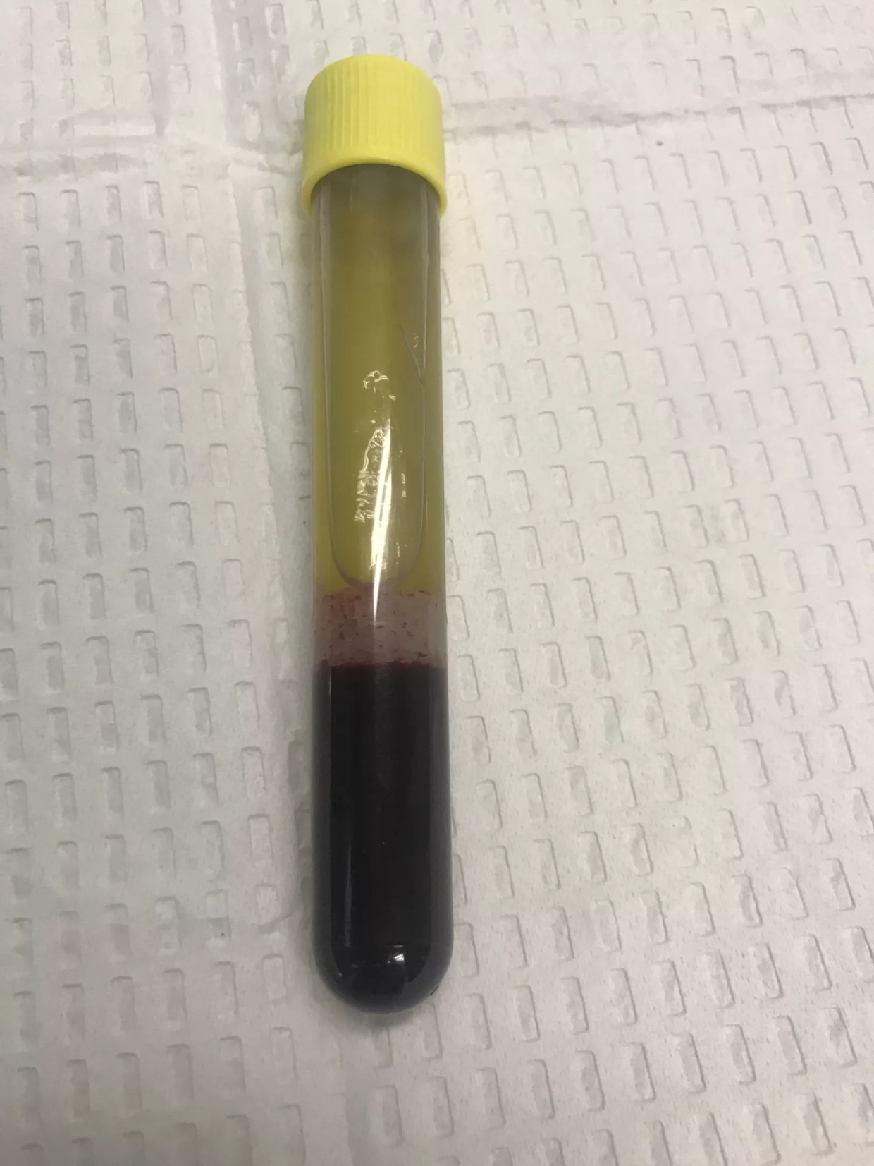 I Got a Face-Numbing Vampire Facial Using My Own Blood and Lived to Tell