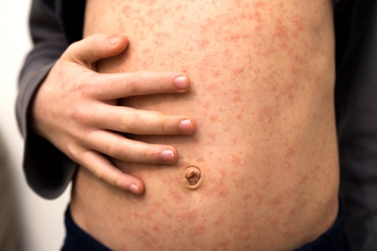 measles on skin